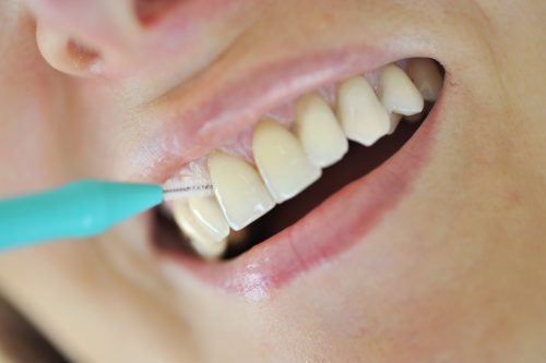 Inter-dental cleaning